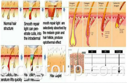 working theory of ipl hair removal